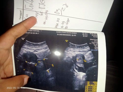 Terdeteksi ada kista