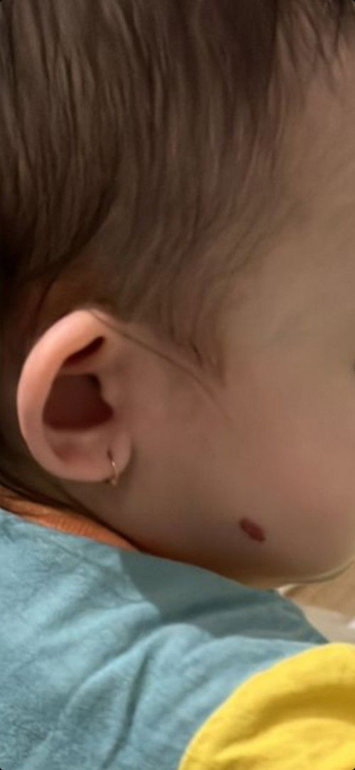 tanda merah di pipi bayi , bagaimana cara menghilangkan nya?