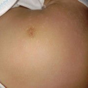 Bayiku didadanya ada bercak putih gitu,cara ngilanginnya gmna ya bunn pdhl sy gak asi?