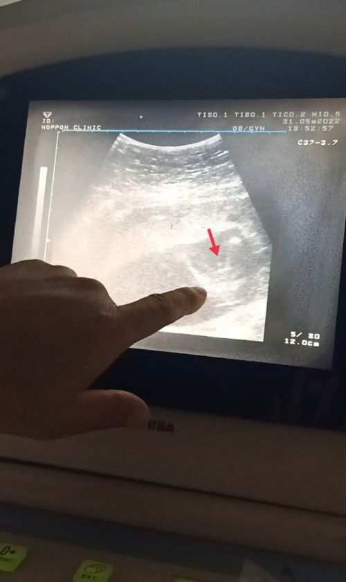 17+2w ทีมพฤศจิกายน65