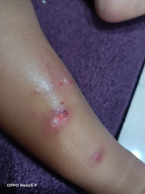 Gatal Info obatnya donk Bun....di kasih di kasih salep sudah. Nanti kering,tumbuh lagi..............