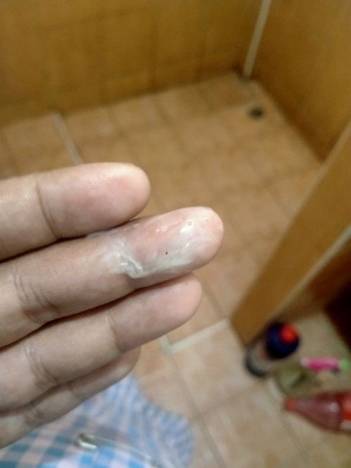 เเม่ๆเป็นแบบนี้เค้าเรียกว่าอะไรคะท้องเเรกทีมมิถุนายน