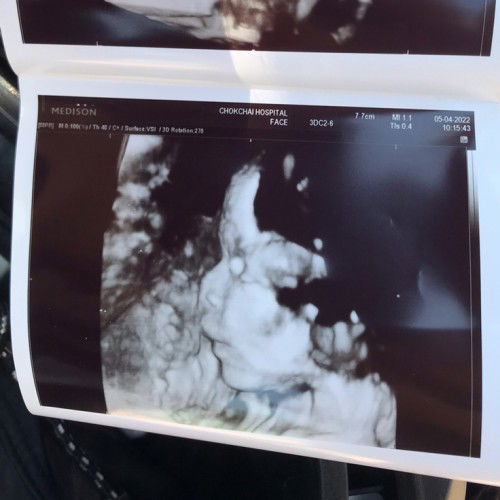 ตอนออกมาก็เอาดั้งมาด้วยนะลูก ตอนนี้หนู 32w6dแล้ว🤍✨