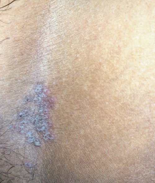 Jamur pada Selangkangan