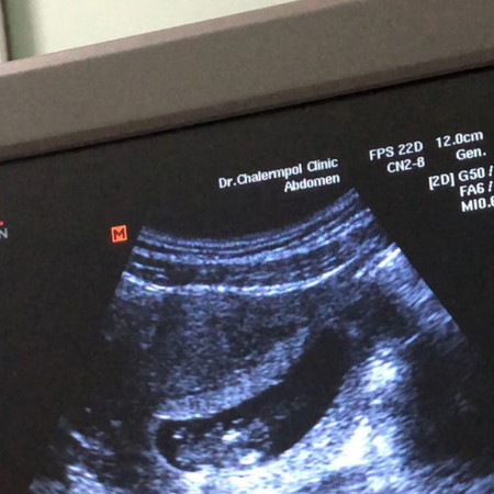 9w6d ท้องแรก