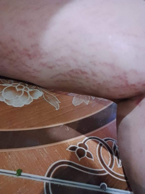 ขาแตกลายแบบนี้ใช้ครีมรัยหายค่ะ