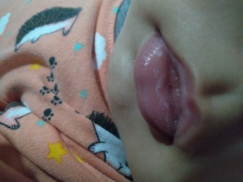 Putoh di bibir bayi