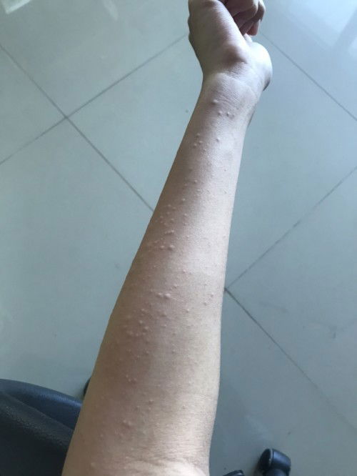 แบบนี้ปกติไหมคะ มีผื่นขึ้น คันมากๆๆๆๆ แรกๆขึ้นที่ก้นและหลัง ต้องเกาตลอด หลังมารามไปขาและแขน ทรมานมากเลยค่ะ คันอะ มันปกติรึอันตรายกับน้องไหมคะ