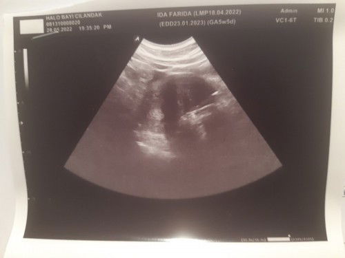 USG 5w tapi blm paham sama hasilnya semoga aj jadi baby