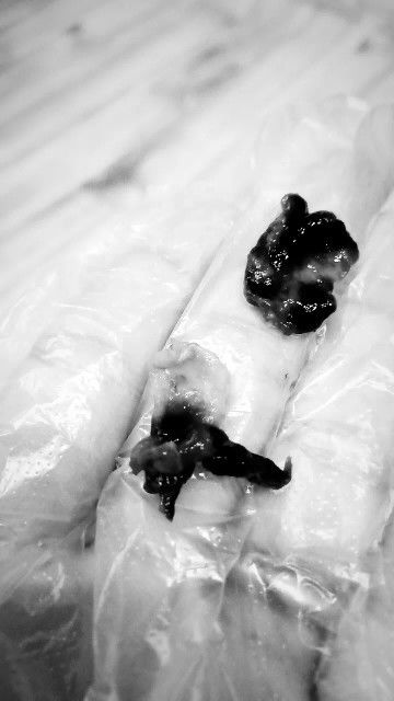 Ini gumpalan darah biasa atau apa ya bund, klo ada yg tau boleh kasih infonya