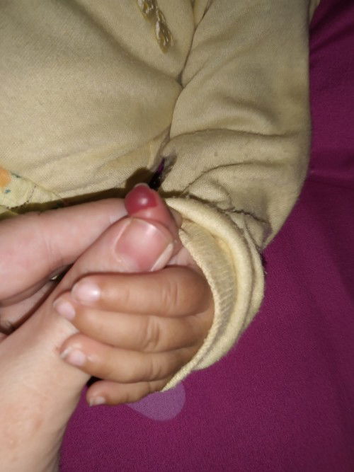 Assalamualaikum Bun mau nanya ada yg begini gak seperti anak saya kata nya ini Hemangioma