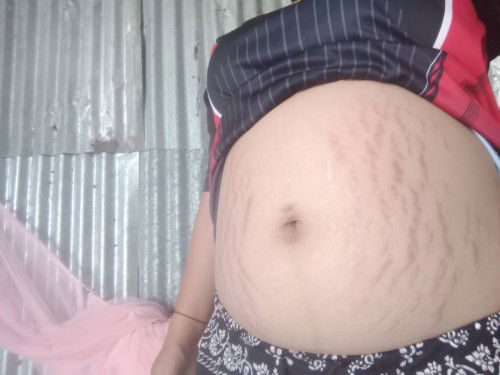 รอยแตกลายหน้าท้อง