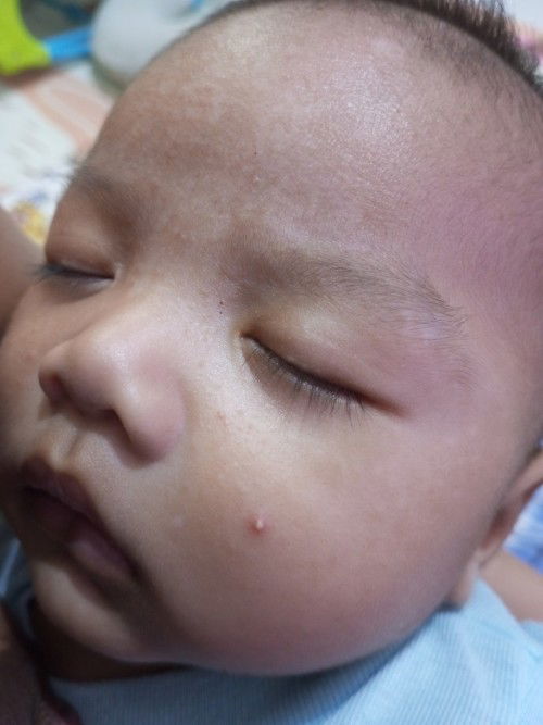 Ada bintik / ruam di pipi