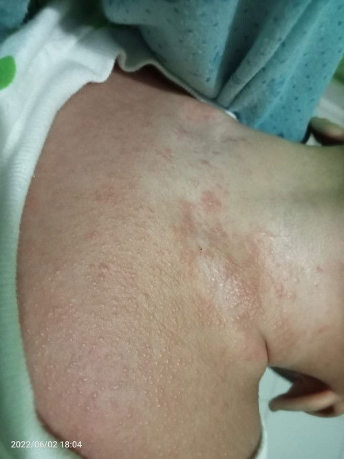 Ruam leher dan wajah