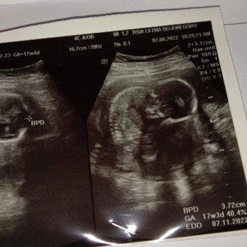 17 weeks
Usg 17 weeks ini bunda 😍
Anak baik lagi posisi seperti orang rukuk dalam sholat 😄🤩