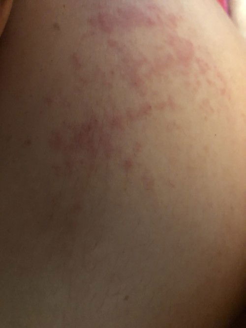 Nổi mẫn ngứa kho mang thai