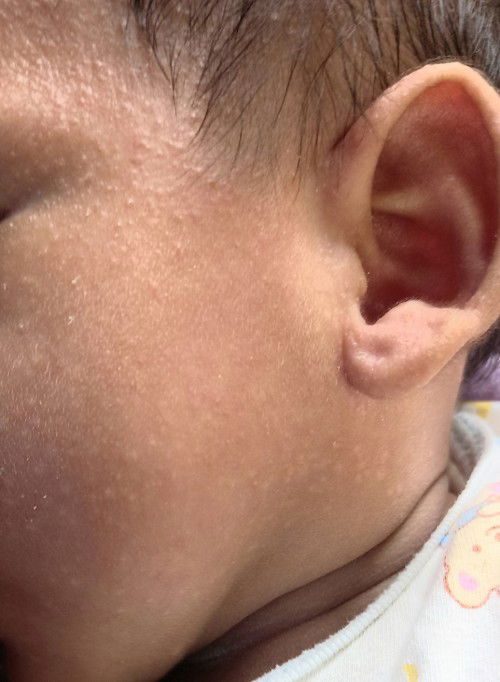 ลูกผื่นขึ้นแบบนี้ มีใครพอรู้มั้ยคะ ใช้อะไรถึงหาย