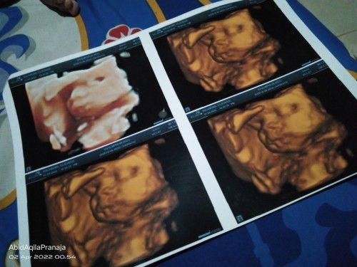 PENGAPURAN PLASENTA 38WEEK