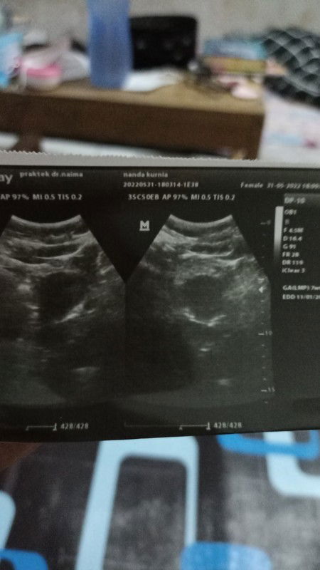 Usg hamil tpi tespeck negatif