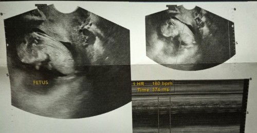 Sharing my US @ 12 weeks 0 days baby and my experience in 1st trimester.