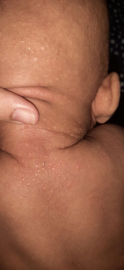 Kulit leher ada timbul bintik2 putih