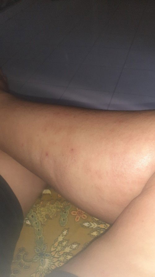 Kaki gatal banget bintik2 merah tiap malan