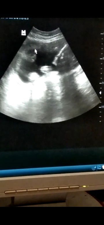 Bun ini gambar baby nya yg mana ya aku bingung krna baru pertama USG, USG 2d