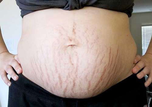 Mom nào biết cách hết rạn mờ thâm k ạ