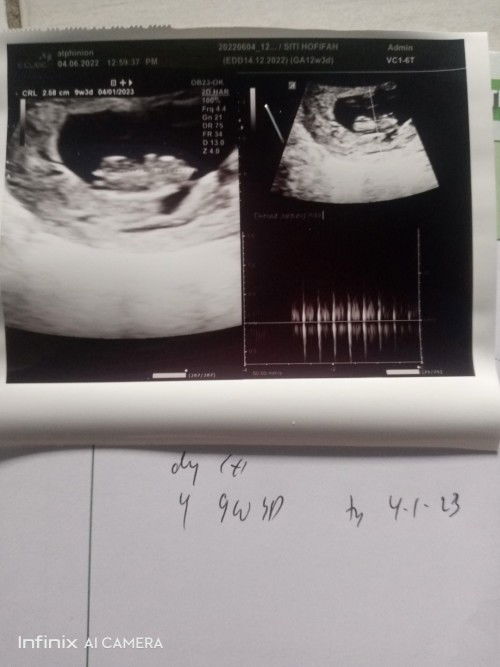 Hasil usg berbeda dengan hitungan hpht