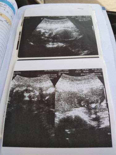 20+6วีค ได้ลูกชายดีใจมาเลยค่ะ