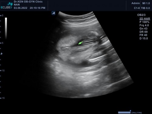 ท้องแรกตื่นเต้น