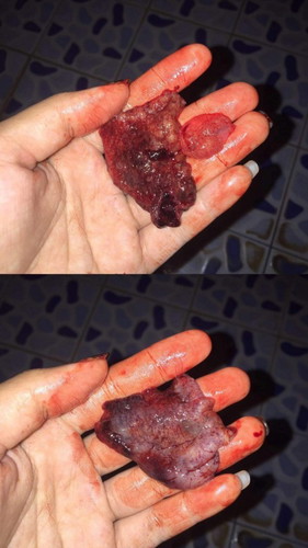 ประจำเดือนขาด