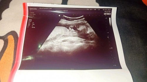 ดูแบบอัลตร้าซาวด์