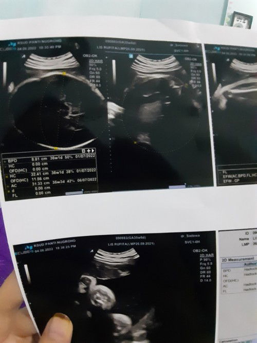 Hasil USG TM3 Bimbang