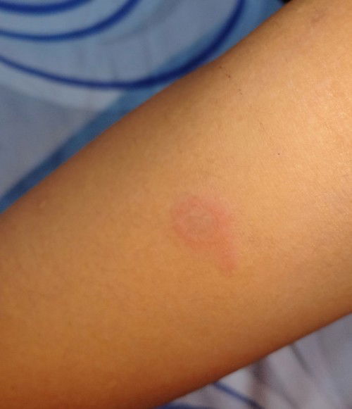 Ruam seperti melepuh