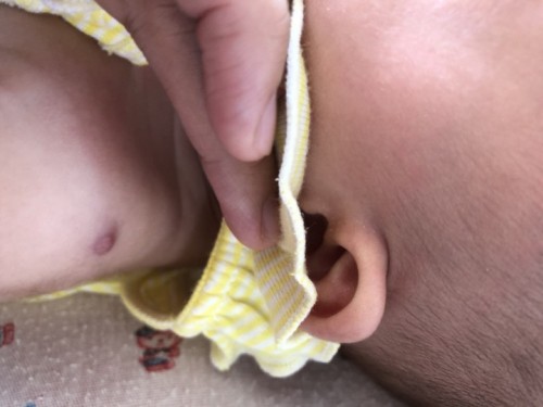 มีแผลนูนแบบนี้ปลูกฝีสำเร็จมั้ยคะ