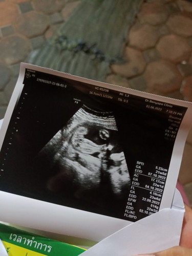 แม่ท่านดูออกบ้างค่ะว่าได้เพศอาไร
ตอบให้หน่อยน่ะค่ะ เต้นตื่น
#ทีมกันยายน65