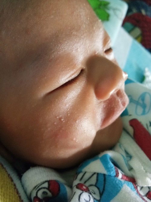 มีตุ่มแดงขึ้นที่หน้า