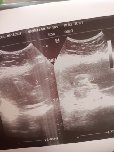 Ultrasound