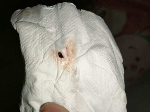 ใช่มูกเลือดหรือไหม?