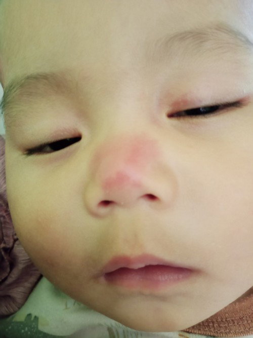 Bayi 6 bulan bisulan