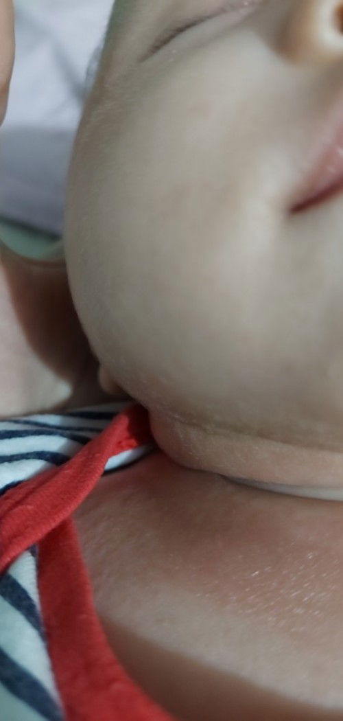 Bé sơ sinh nổi đỏ sần