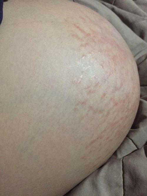 แตกลายแถมเป็นผื่นแดง