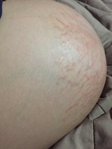 แตกลายแถมเป็นผื่นแดง