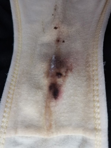 vaginal discharge