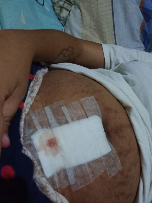 Mah 3 weeks na po ng ma cs ako, ano po kaya to? Parang nanariwa yun tahi.