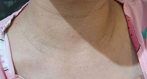 ใครท้องแล้วมีกระที่คอบ้าง