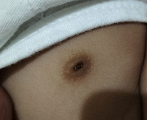 Sore / Wounded Nipples of Baby