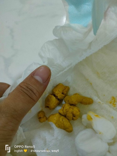 อึแบบนี้ ควรเปลี่ยนนมยี่ห้อไหนดีคะ