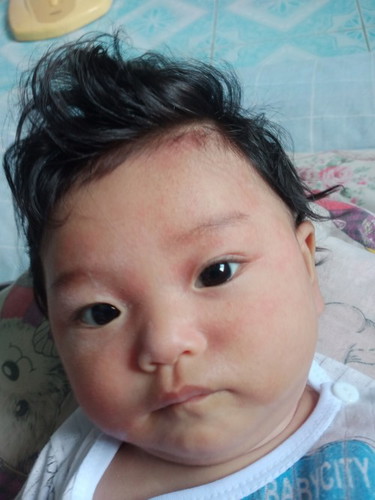 ผื่นขึ้นเต็มหน้า